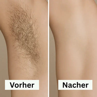 IPL Laser-Haarentfernungsgerät Rozenda